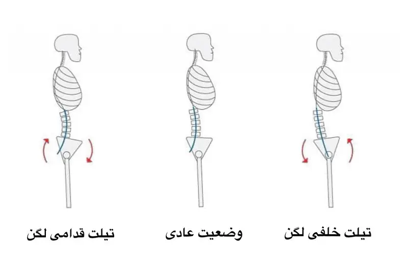 ۱- تیلت لگن قدامی Anterior pelvic tilt ۲- تیلت لگن خلفی Posterior pelvic tilt 