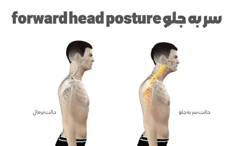 سر به جلو forward head posture