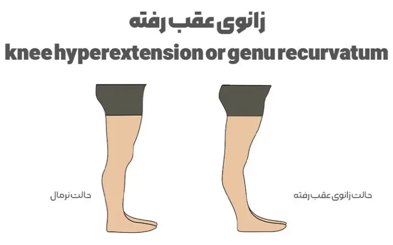 زانوی عقب رفته knee hyperextension or genu recurvatum