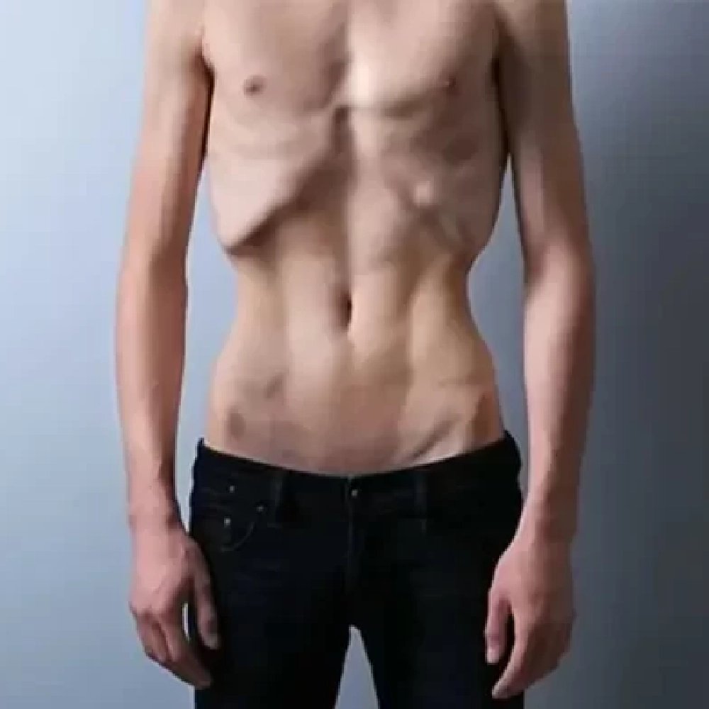 ANOREXIA
